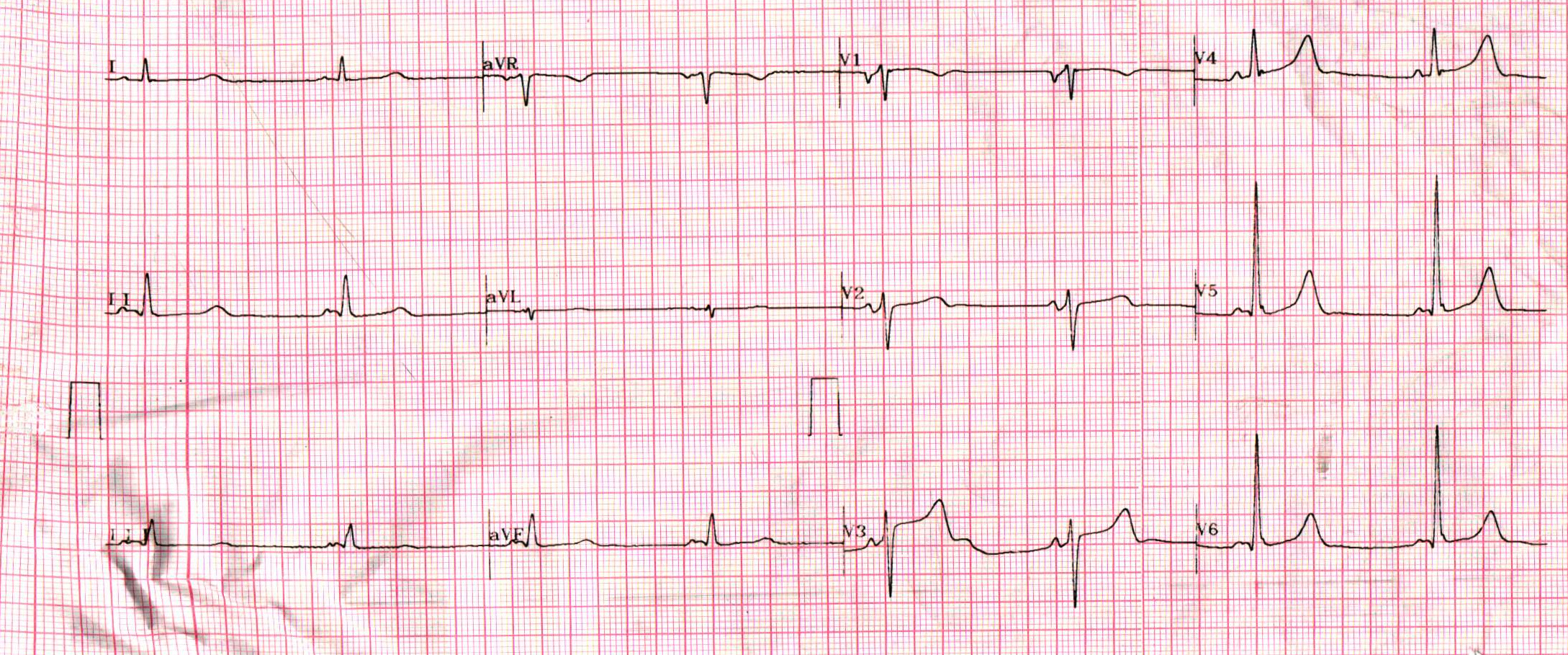 Wpw Syndrome How To Read Ecg