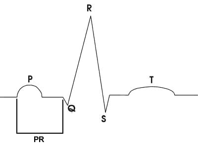 P-R_interval.jpg
