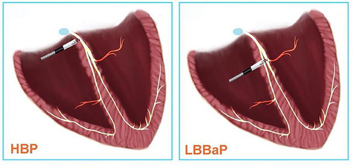 hbp_vs_lbap.jpg