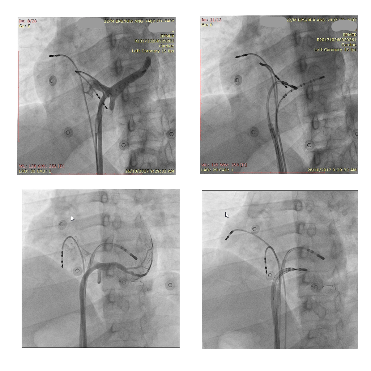 no_diverticulum.jpg