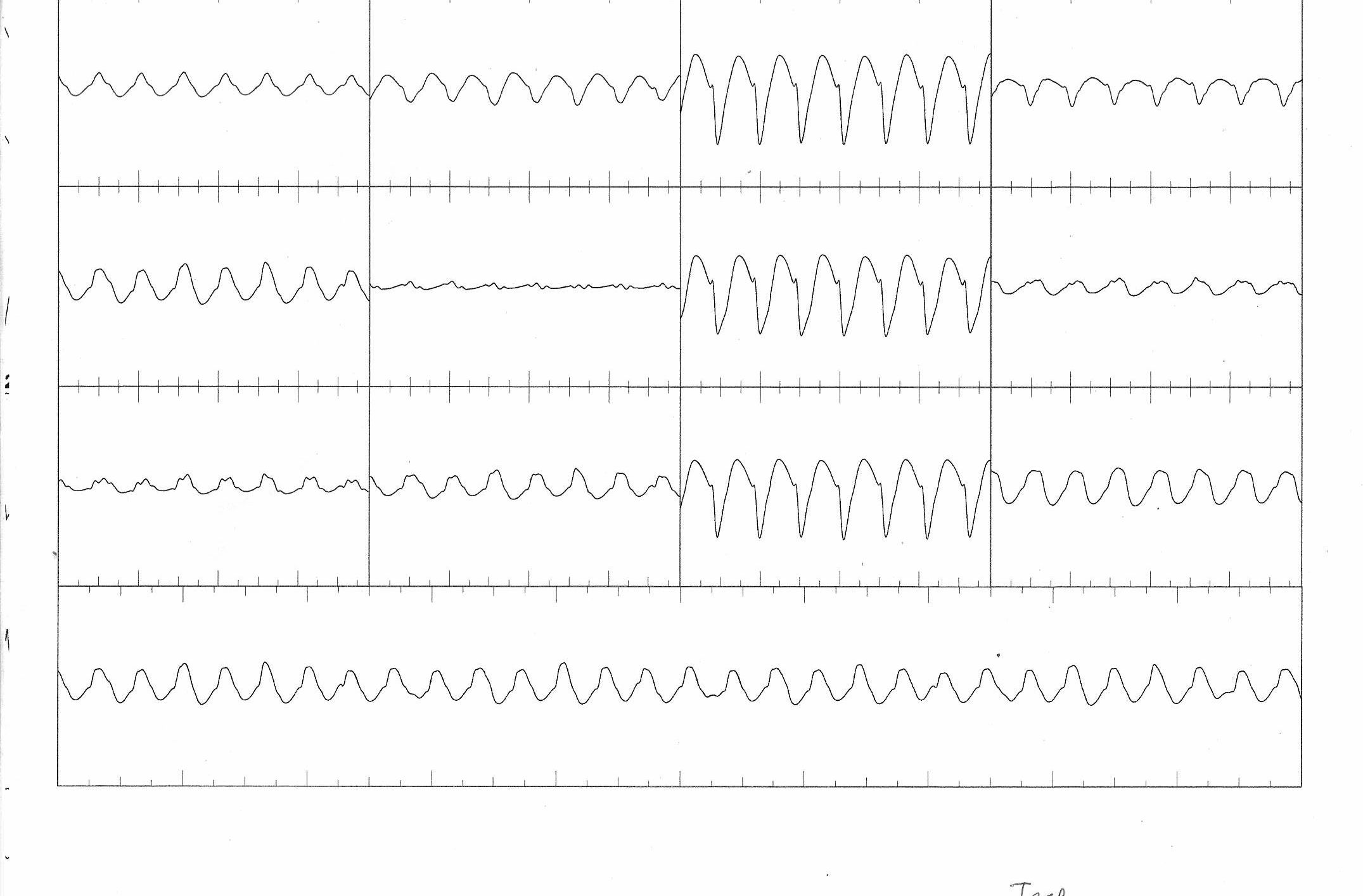 05_tachy_ecg.jpg