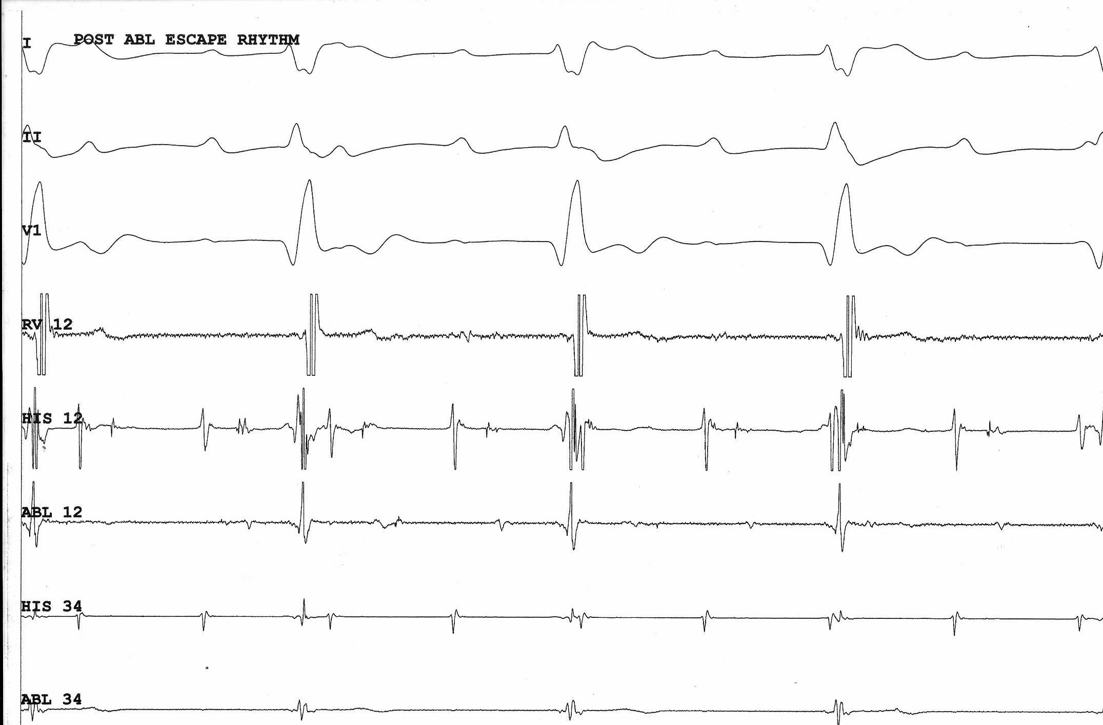 10_post_abl_infra_his_block.jpg