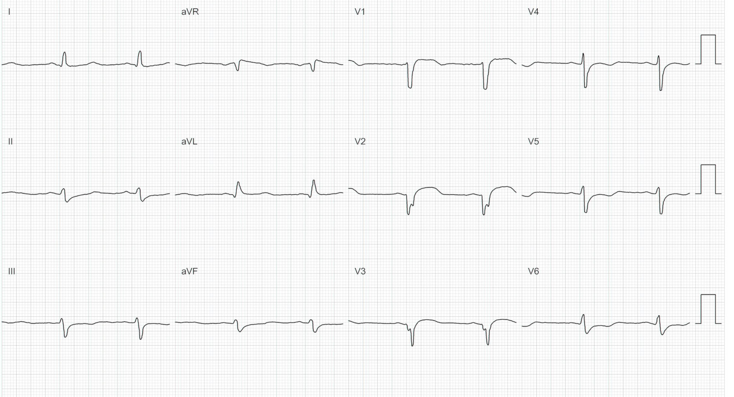 basal_ecg.jpg