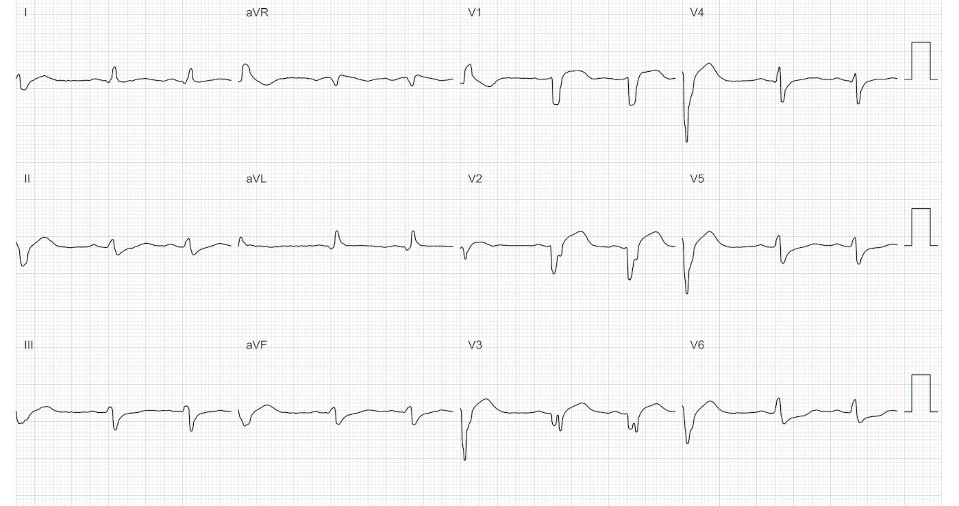 post_ablation_ecg1.jpg