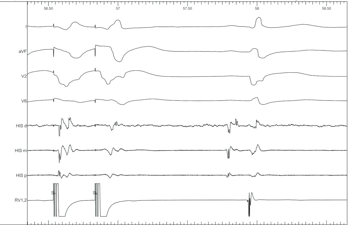 tachy_induction_vh_jump1.jpg