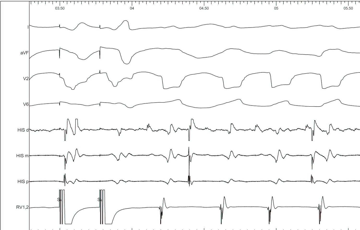 tachy_induction_vh_jump2.jpg