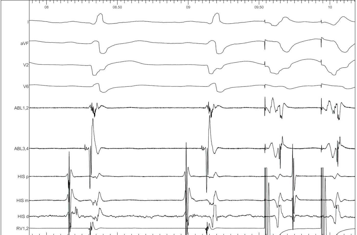 vt_induction_with_lb1.jpg