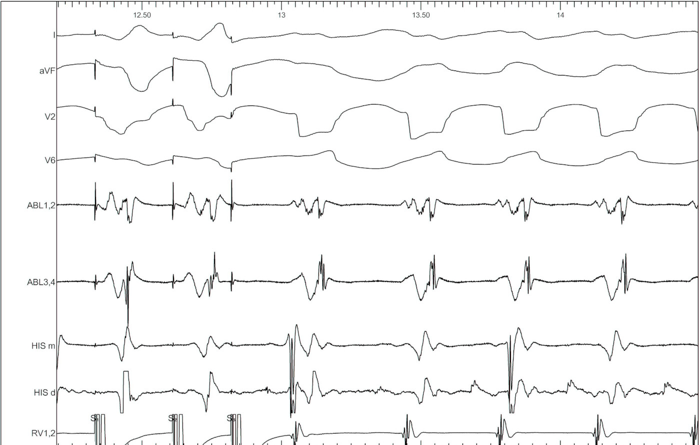 vt_induction_with_lb2.jpg