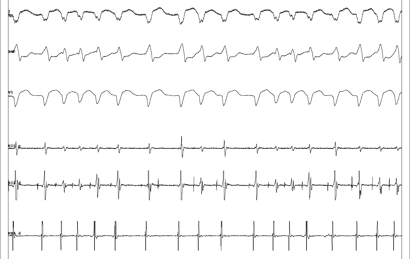 avj_ablation.JPG