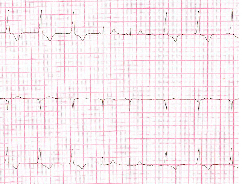 pacemaker_fn_teaching.jpg