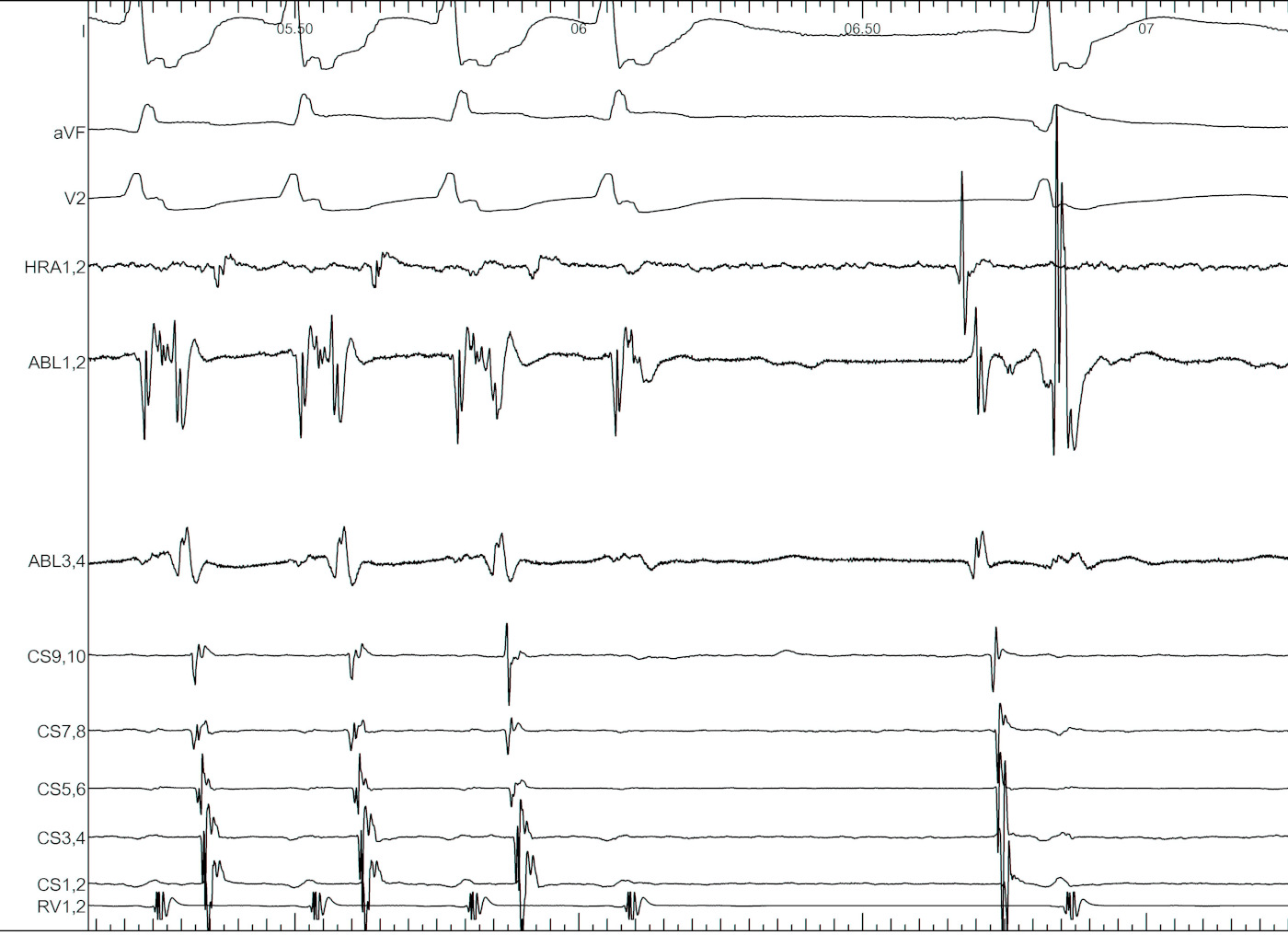 asap_ablation_tachy.jpg