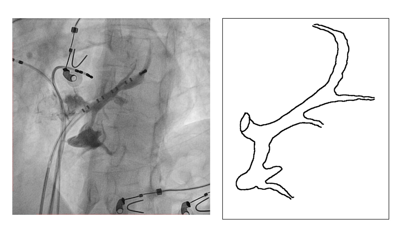 diverticulum.jpg