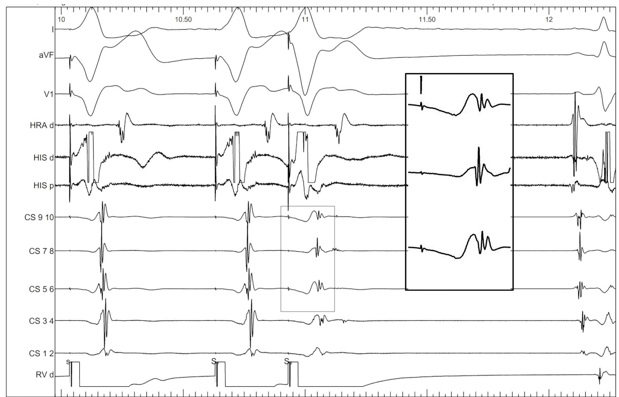 epicardial_ap_signal_sequence.jpg