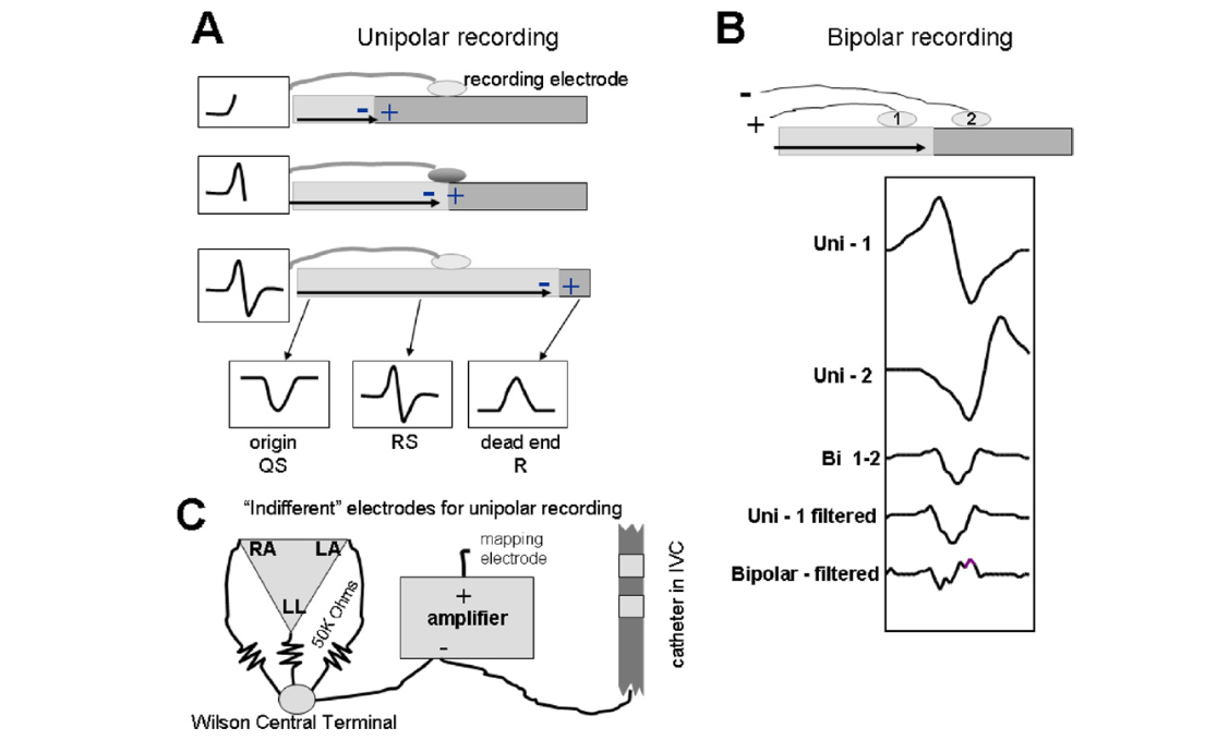 unipolar_egm.png