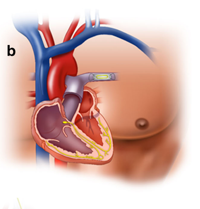 cardiomem.png