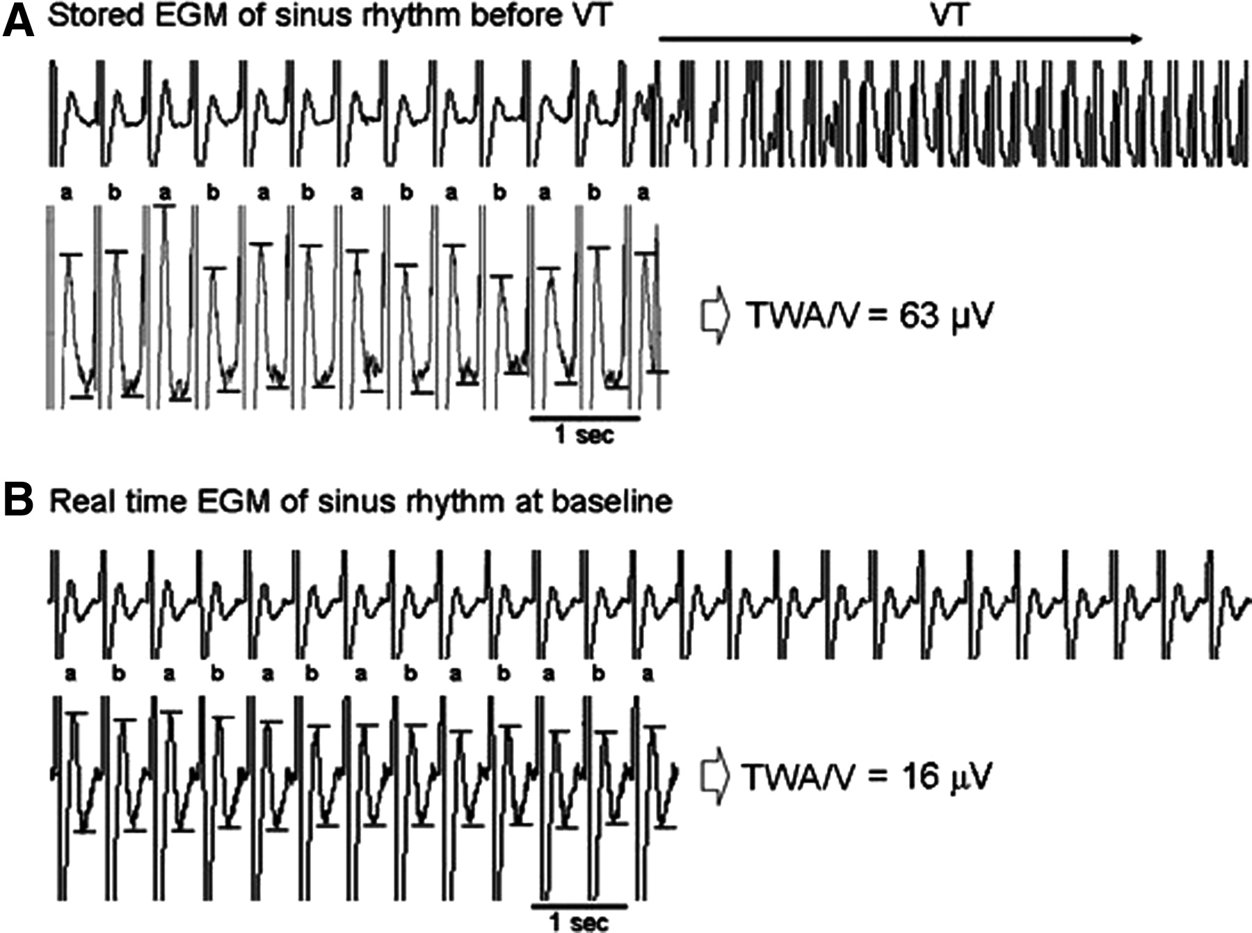 egm_alternans.jpeg