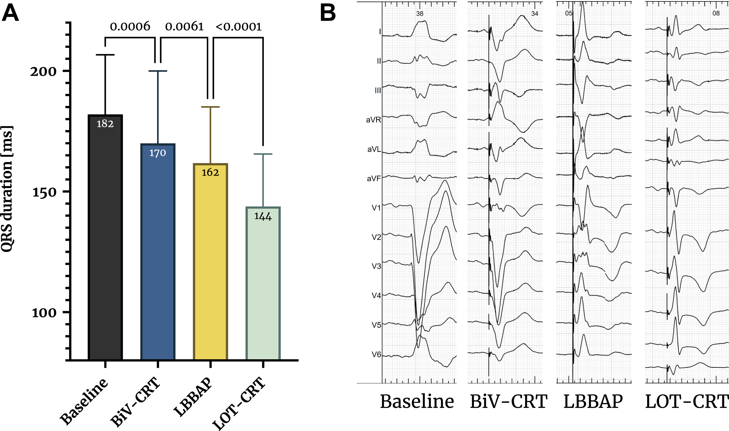 qrs_duration_lot.jpg