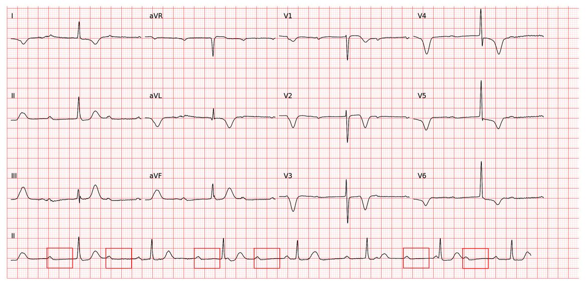 atrial_repol1.jpg