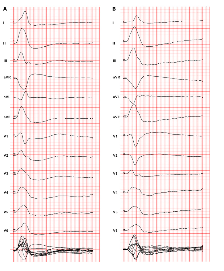 atrial_repol2.jpg