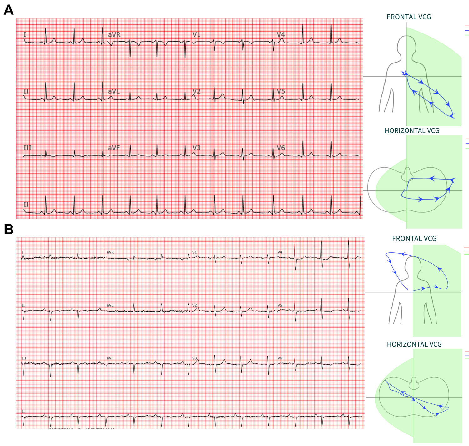 ecg-vcg.jpg