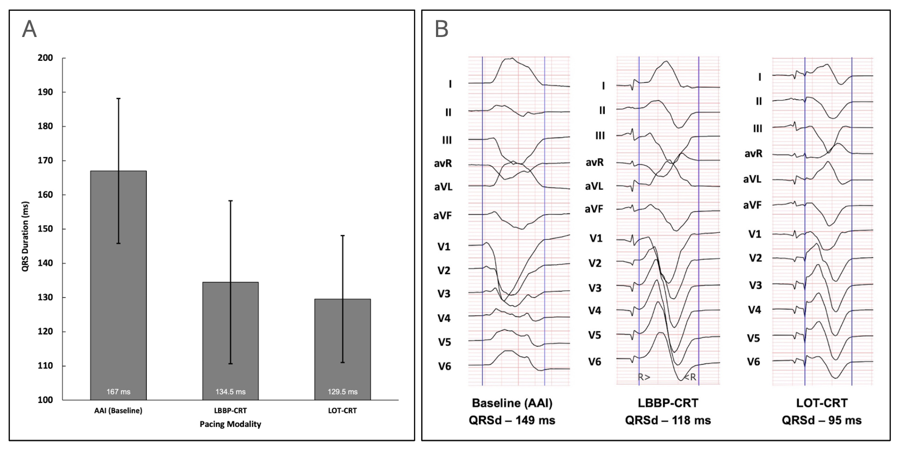 qrs_duration.jpg
