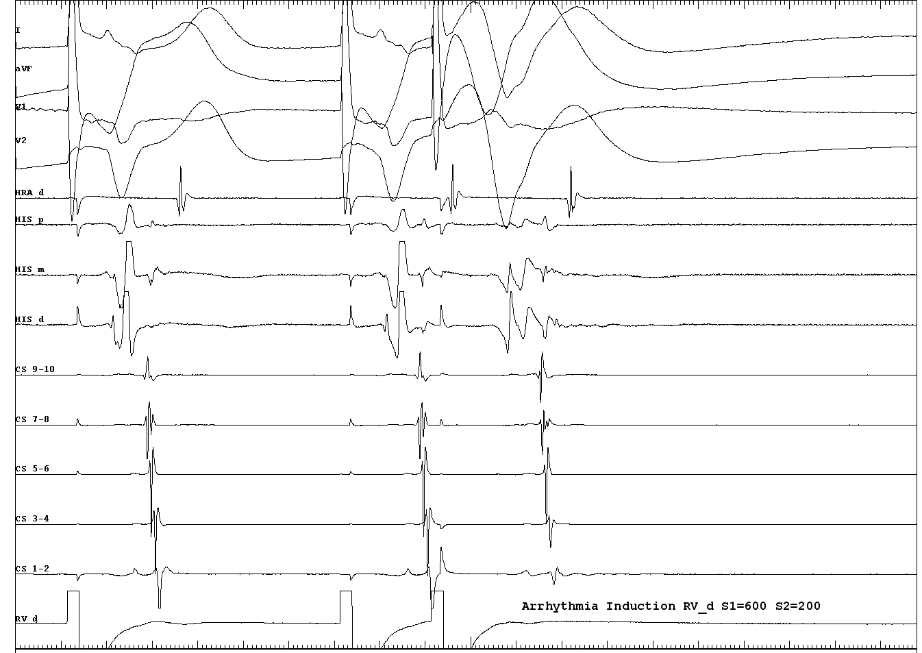 manas_retrograde_conduction.png