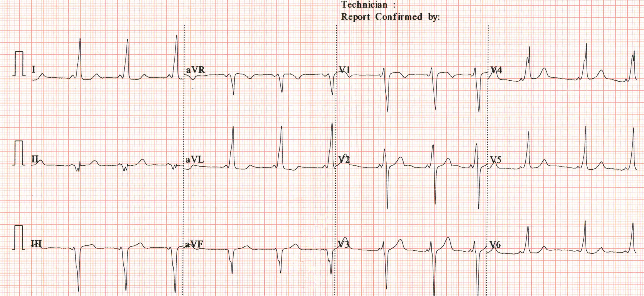pavithra_ecg_1.png