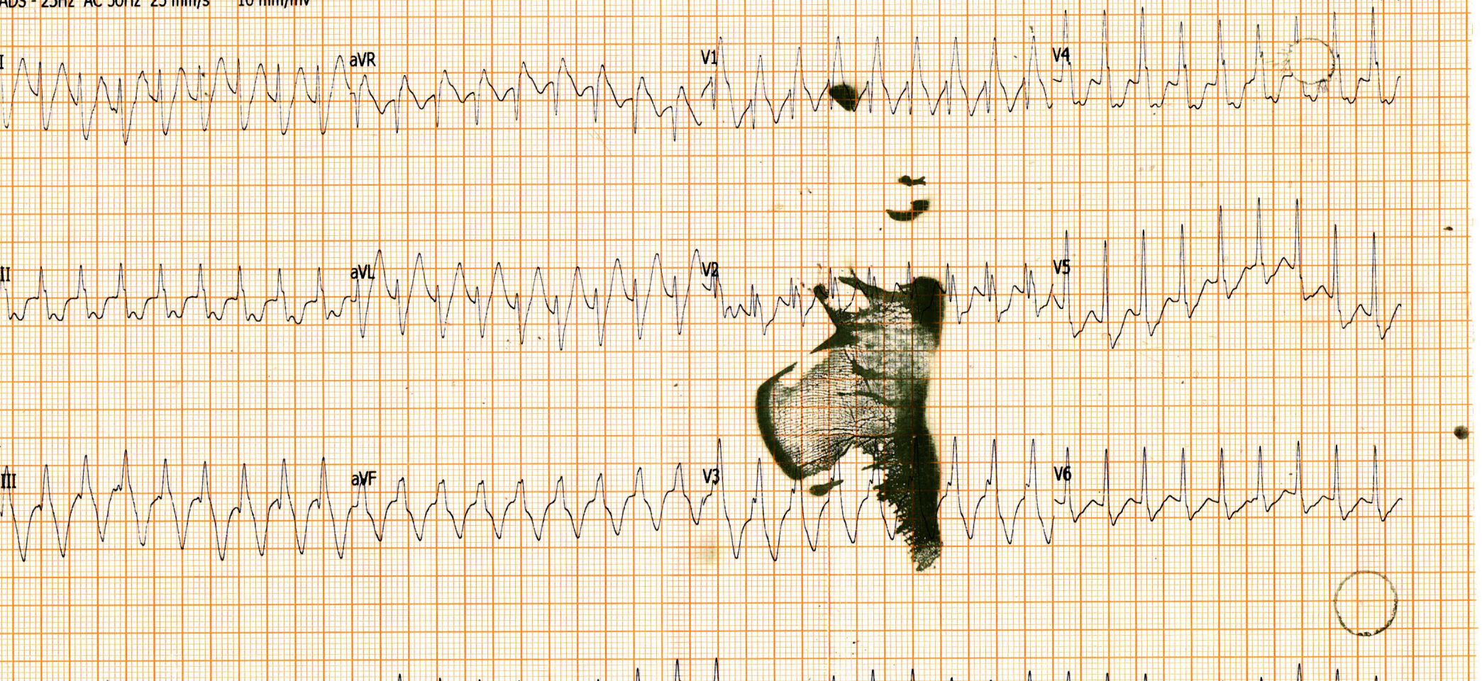 pavithra_ecg_2.png