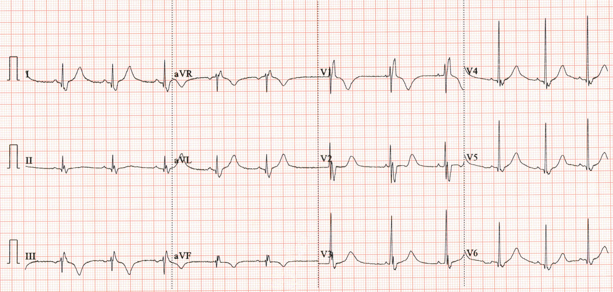 pavithra_ecg_3.png