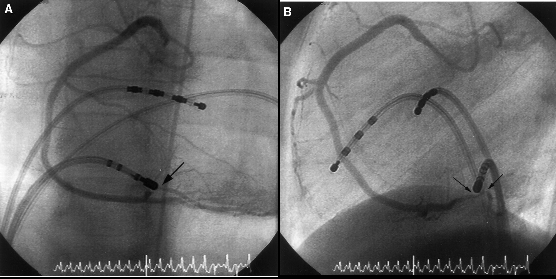 coronary_stenosis.jpeg