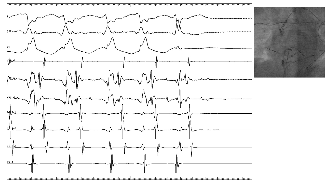 multiple_ap_differential_coumel.png