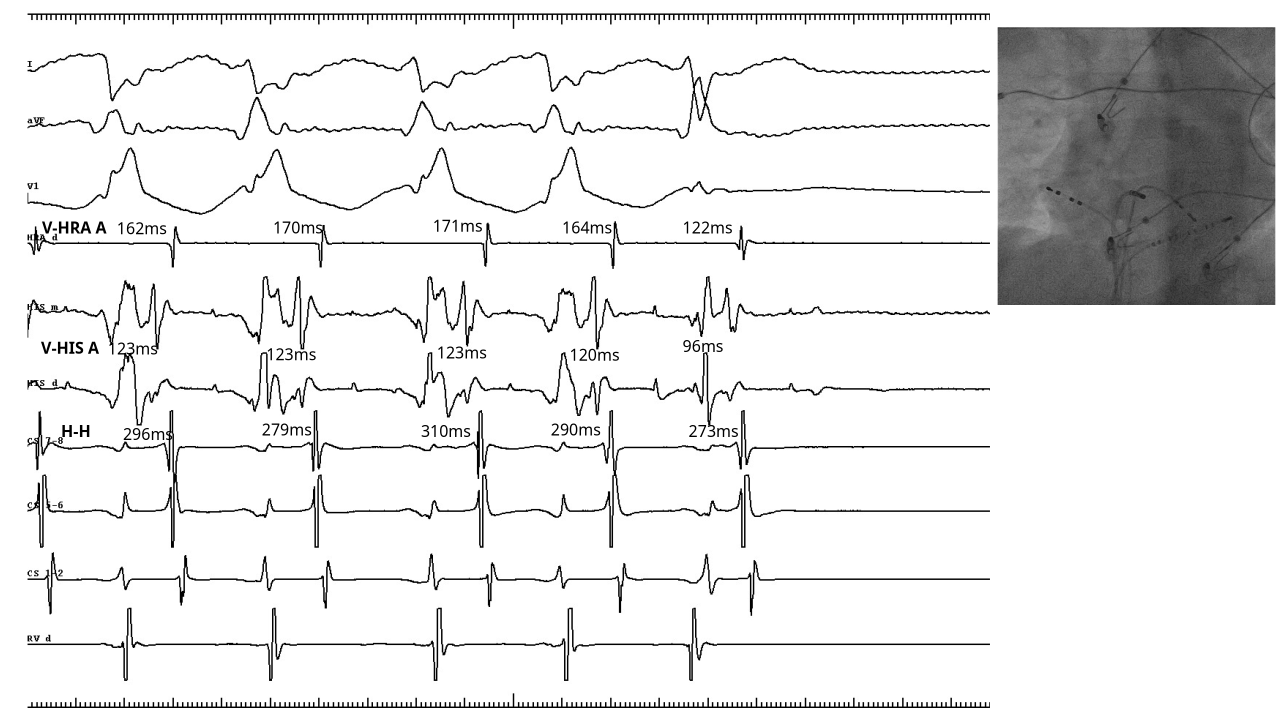 multiple_ap_differential_coumel_meas.png