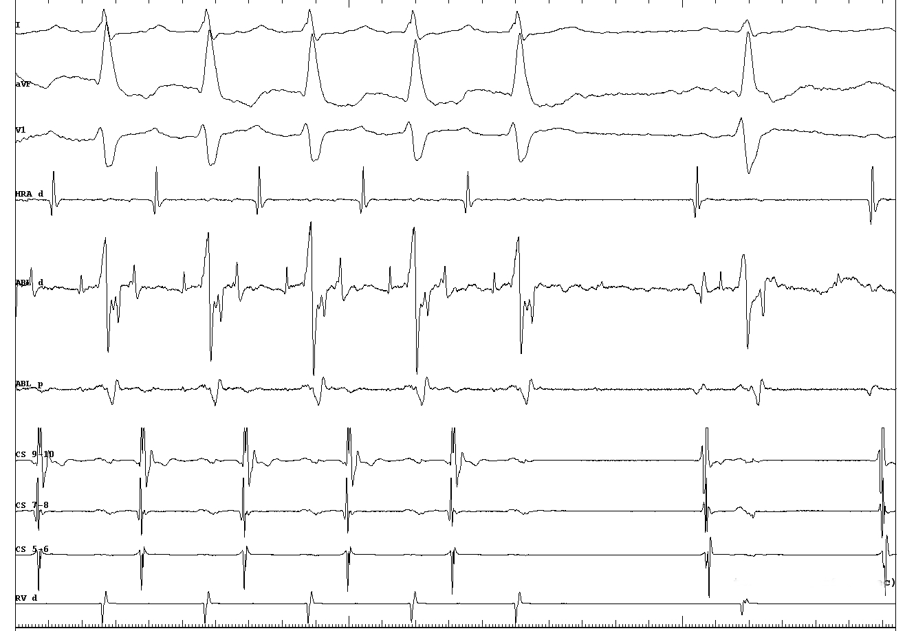 parahisian_AP_ablation.JPG