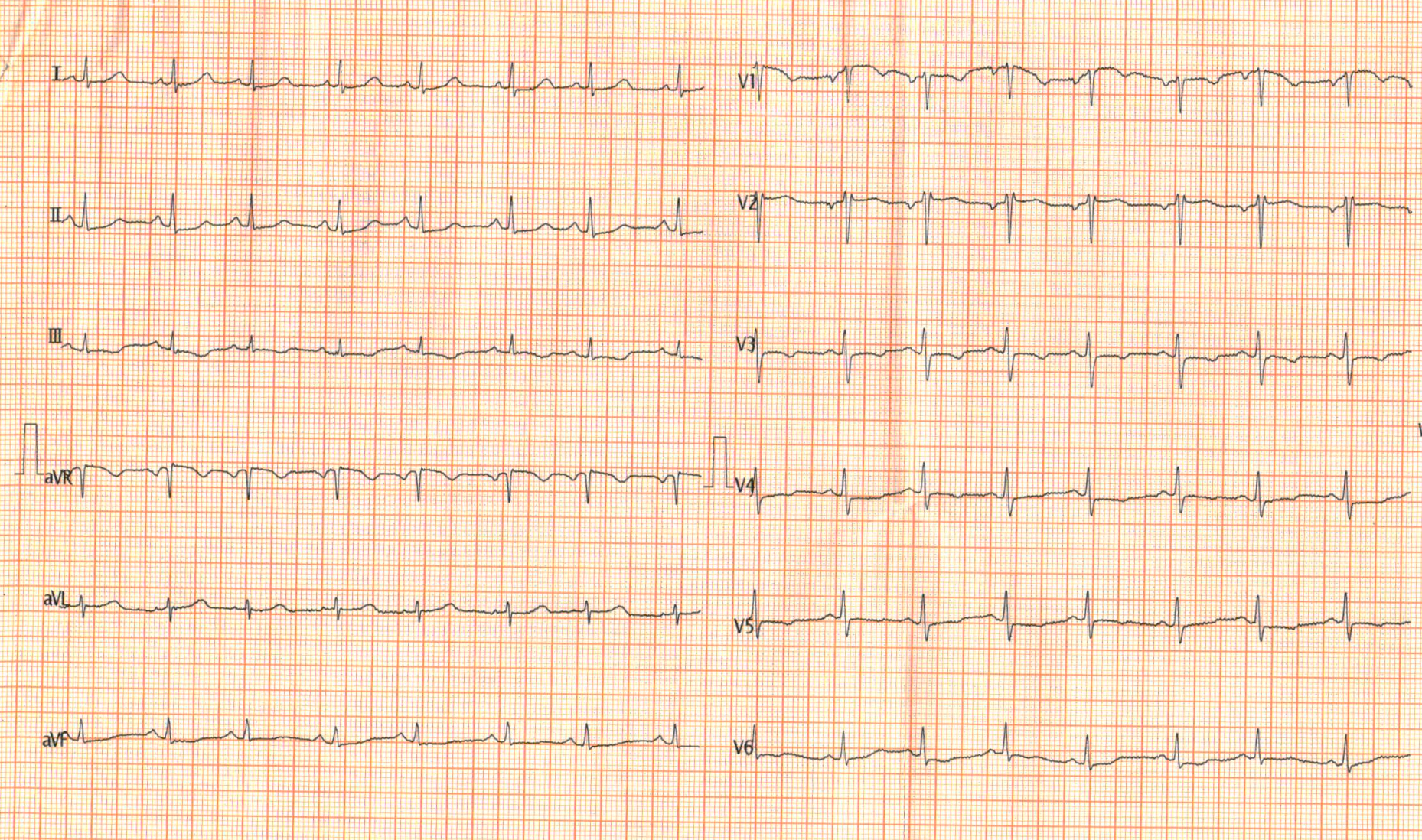 ecg_sinus.png