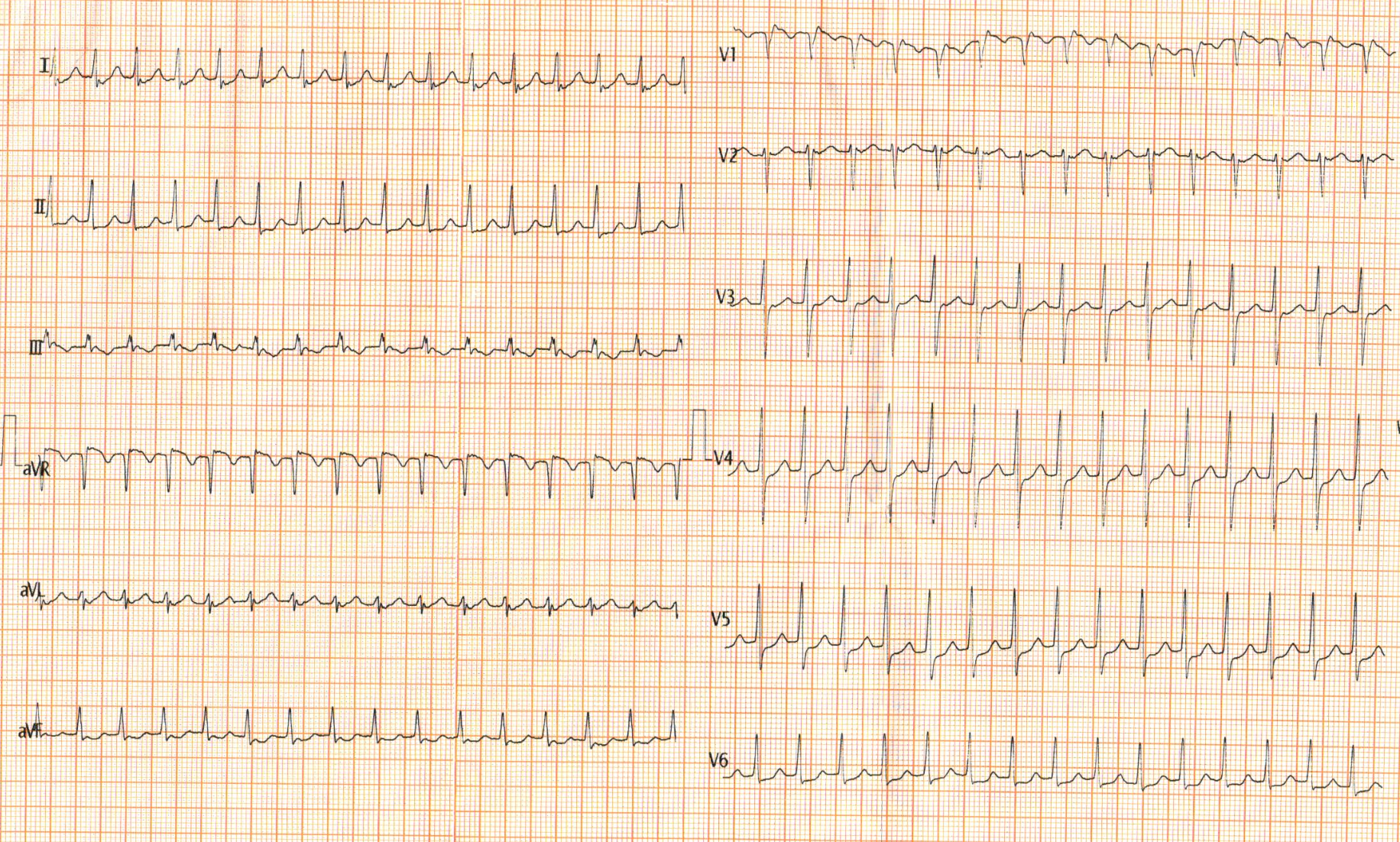 ecg_tachy.png