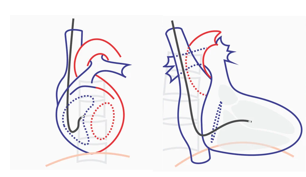 septal_position.png